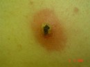 CLOSE UP OF DAVE NASTY BITE ON HIS BACK 195 * 448 x 336 * (12KB)